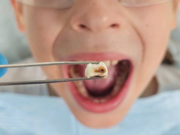 Best Emergency Broken Tooth Repair in Glenville, WV